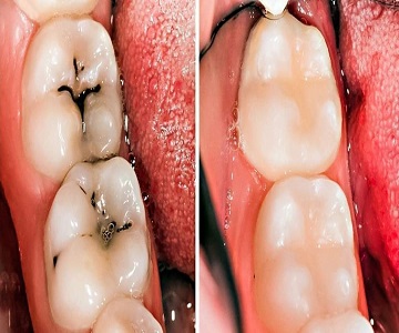 Recettes naturelles pour un  mal de dent (caries dentaires) et les personnes ayant une mauvaise haleine 